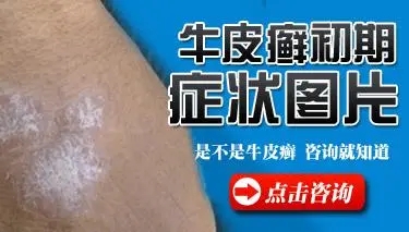 牛皮癣的早期症状是什么