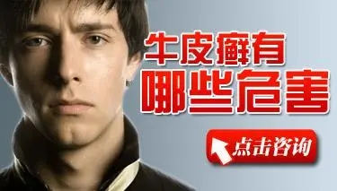 牛皮癣的常见危害有哪些